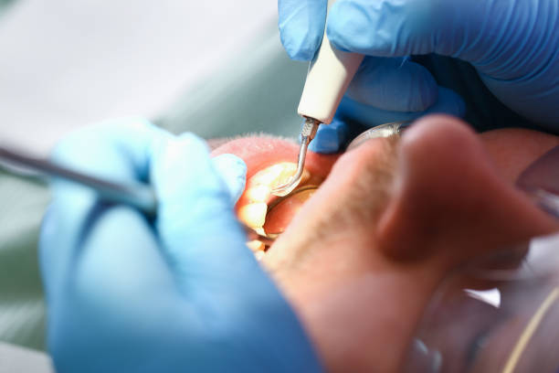 Best Emergency Dental Extractions in Anchorage, AK